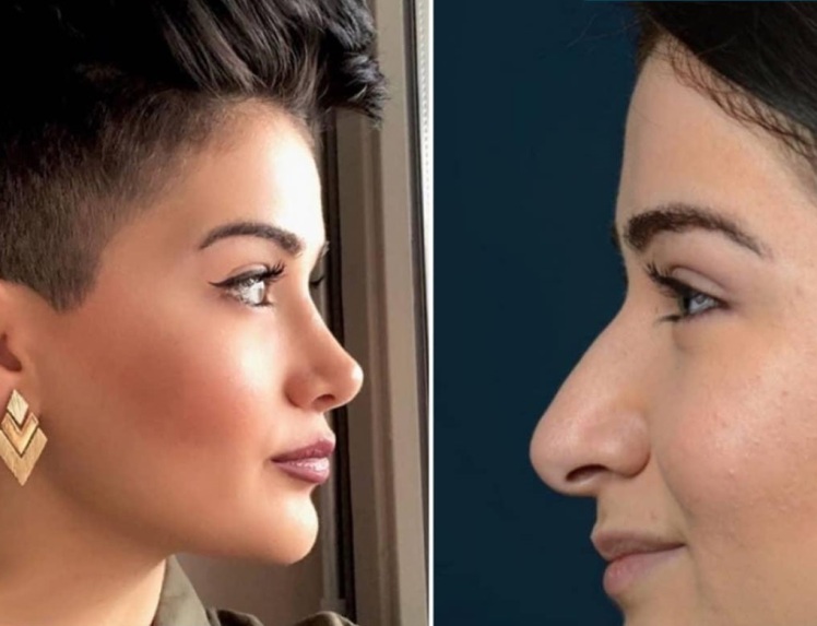 انواع جراحی های بینی را باهم بشناسیم 